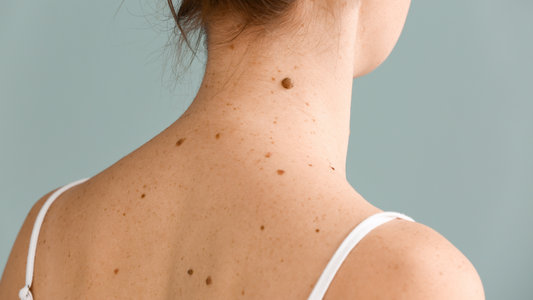 Solbari blog: Why do I get moles on my skin?