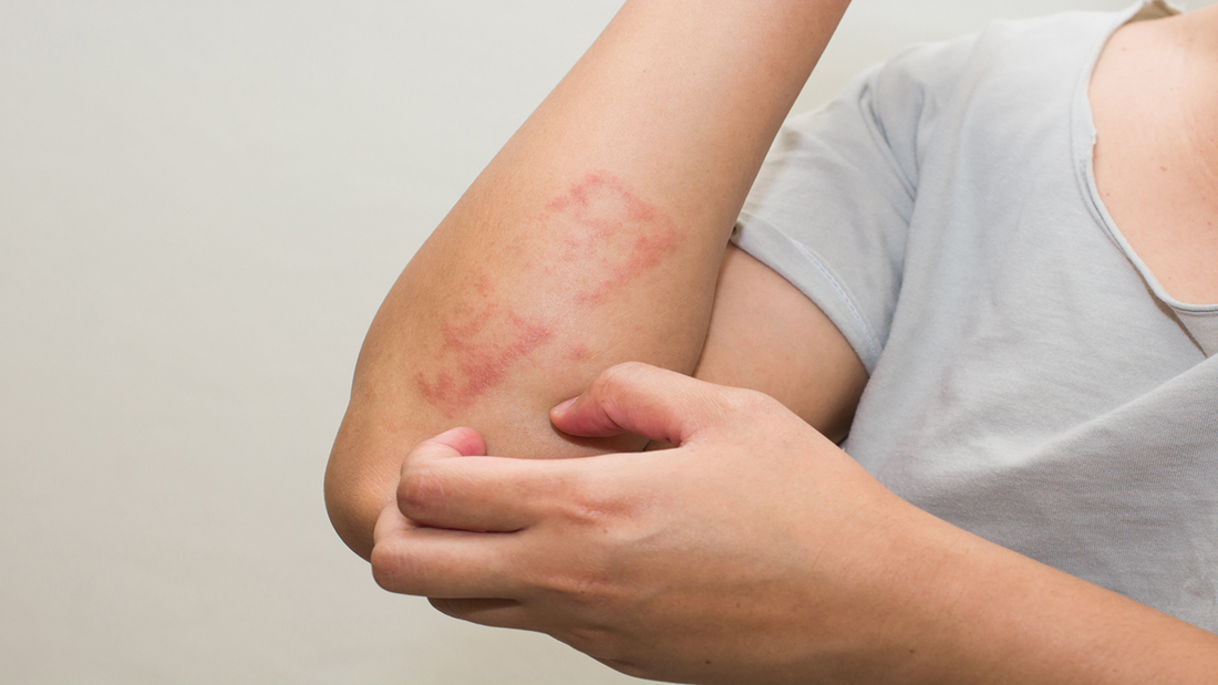 Solbari blog: What is psoriasis?